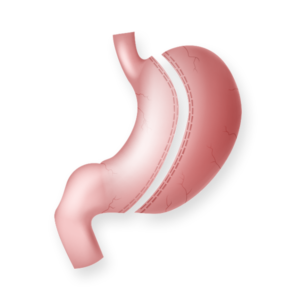 Diagram of gastric sleeve surgery