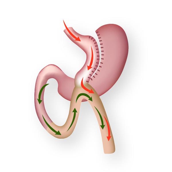 Diagram of gastric bypass