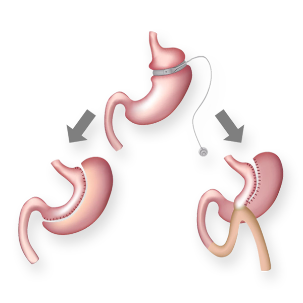 Bariatric Revision Surgery